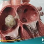 الورم المخاطي