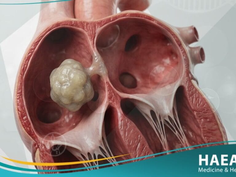 الورم المخاطي