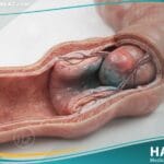 انغلاف الأمعاء