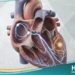 _انقباضة خارجة