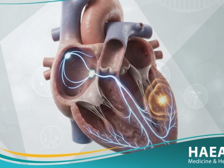 _انقباضة خارجة