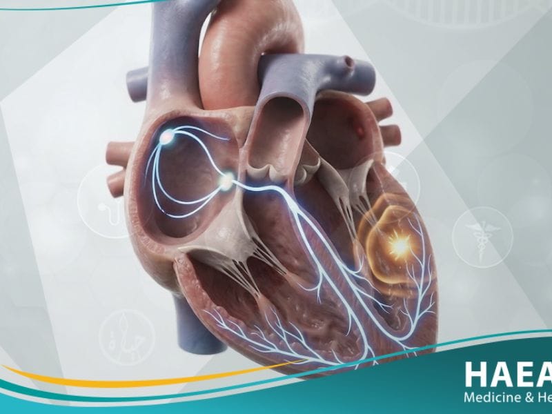 _انقباضة خارجة