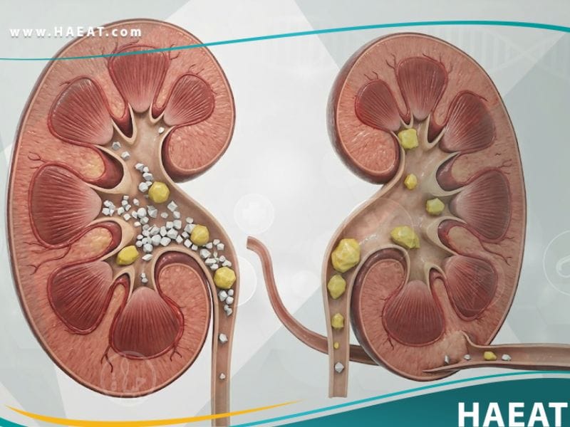 _بيلة سيستينية