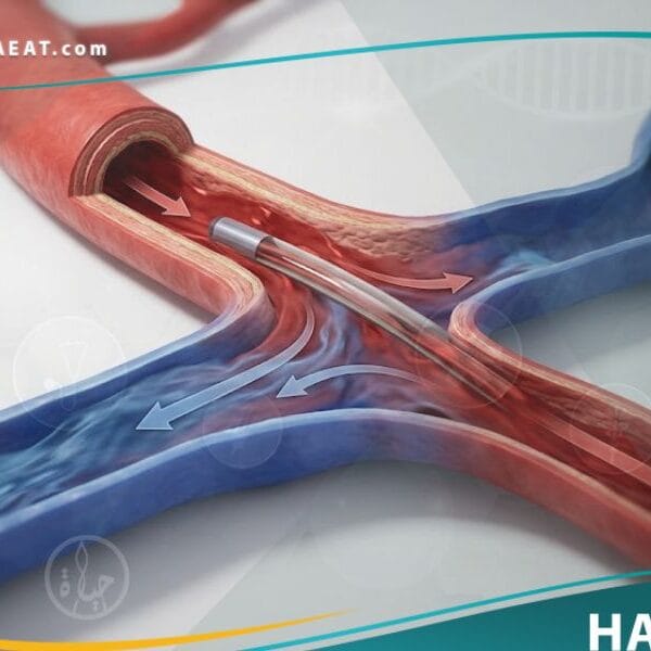 تحويلة وعائية