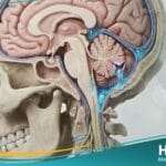 تسرب السائل النخاعي