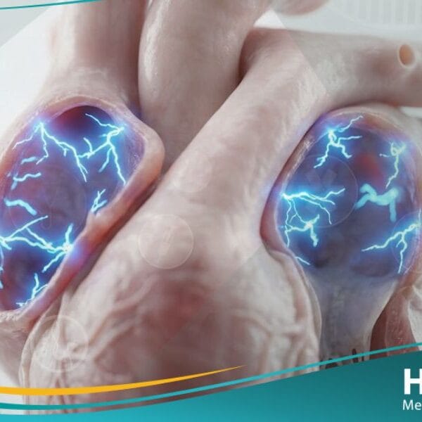 تسرع القلب الأذيني