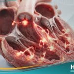 تسرع القلب البطيني