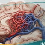 تشوه شرياني وريدي