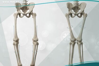 تشوهات تدويرية وزاوية في الرجلين