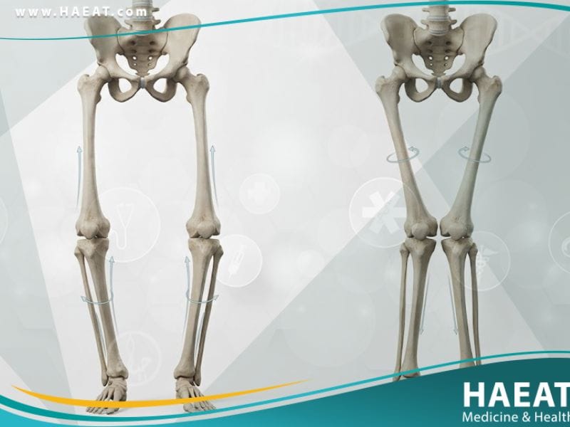 تشوهات تدويرية وزاوية في الرجلين