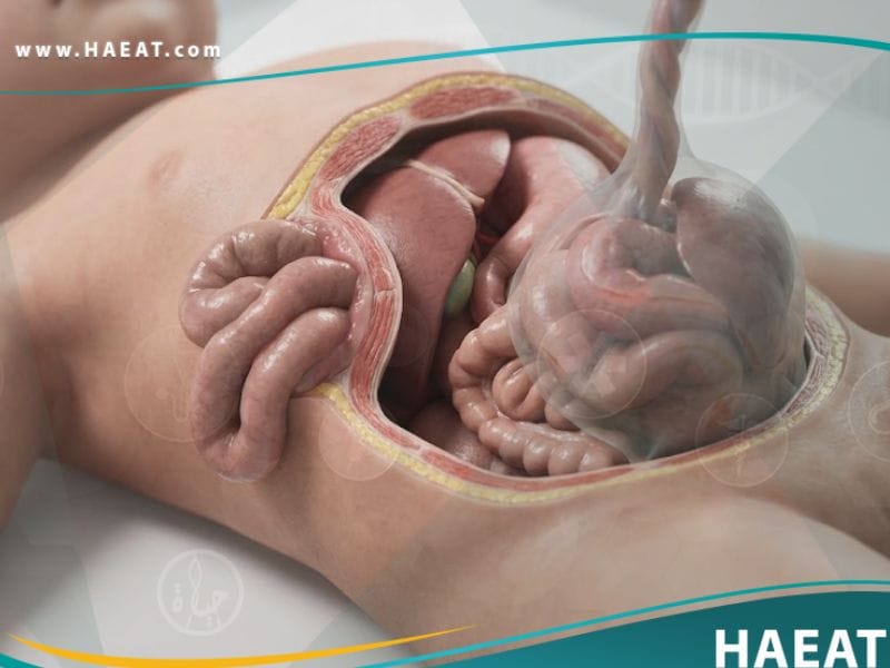 _تشوهات خلقية في جدار البطن