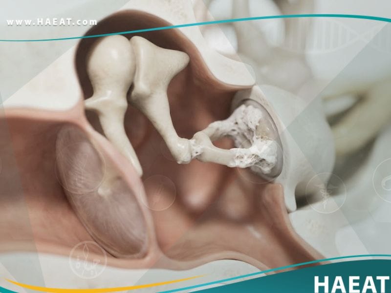 تصلب الأذن الوسطى