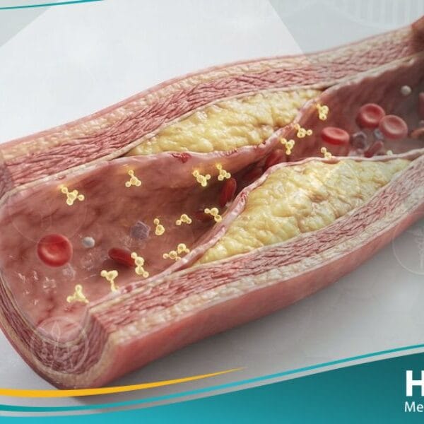 تصلب الشرايين لدى مرضى السكري