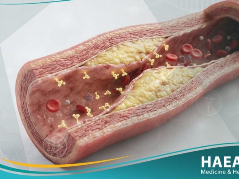 تصلب الشرايين لدى مرضى السكري