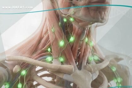 تضخم العقد اللمفية