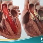 تضيق الصمام الابهري (1)