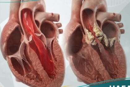 تضيق الصمام الابهري (1)