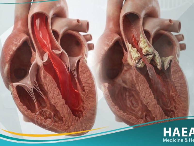 تضيق الصمام الابهري (1)