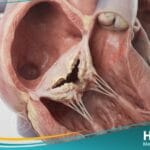 تضيق الصمام الثلاثي الشرف (1)