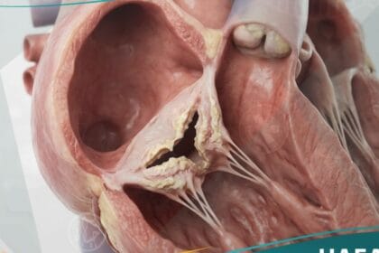 تضيق الصمام الثلاثي الشرف (1)