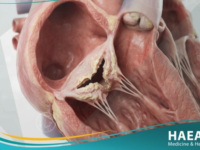 تضيق الصمام الثلاثي الشرف (1)