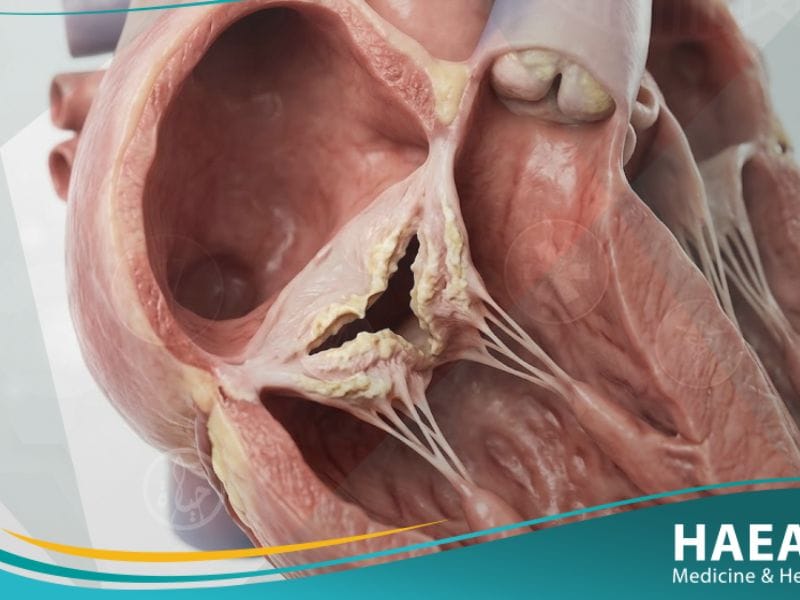 تضيق الصمام الثلاثي الشرف (1)