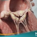 تضيق الصمام المترالي