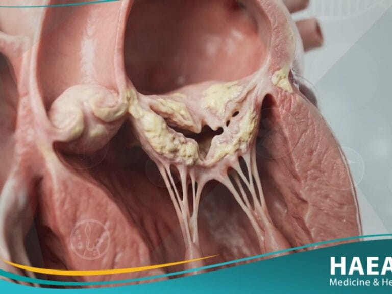 تضيق الصمام المترالي