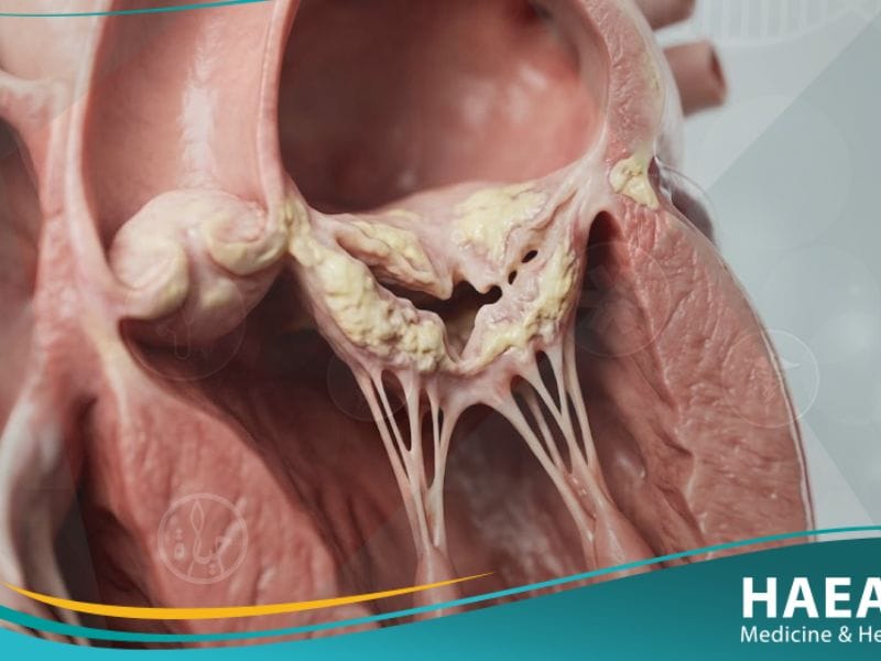 تضيق الصمام المترالي