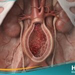 تمدد الشريان الأورطي البطني