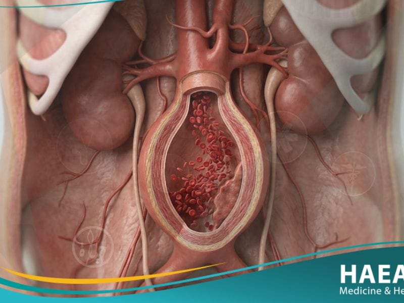 تمدد الشريان الأورطي البطني
