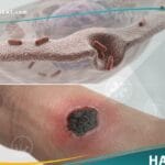 تيفوس أكالي