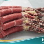 حثل العضلات (1)