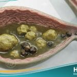 حصى المرارة