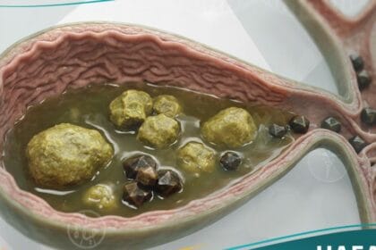 حصى المرارة