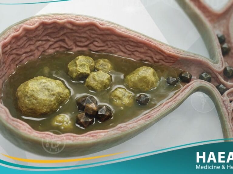 حصى المرارة