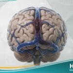 خثار في الجيوب الوريدية الدماغية