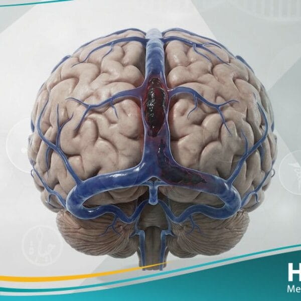 خثار في الجيوب الوريدية الدماغية