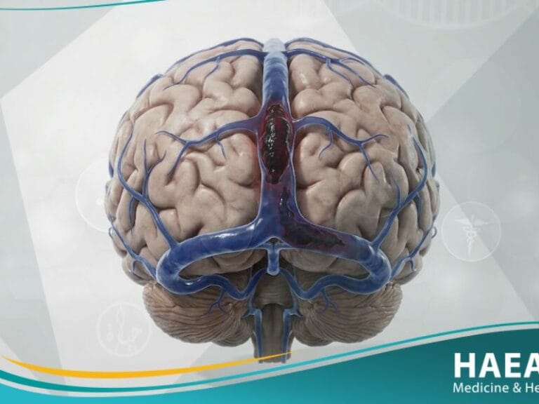 خثار في الجيوب الوريدية الدماغية