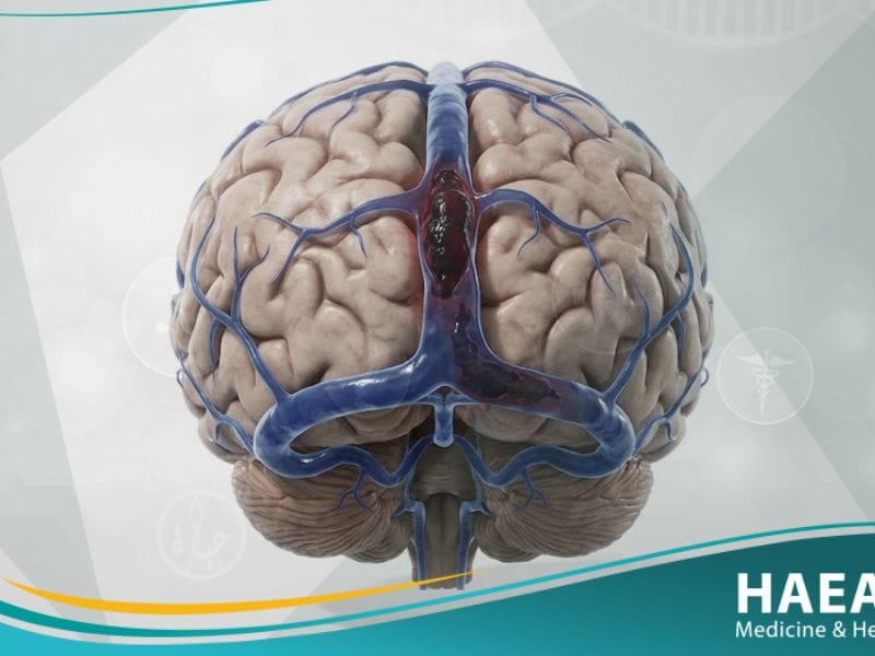 خثار في الجيوب الوريدية الدماغية