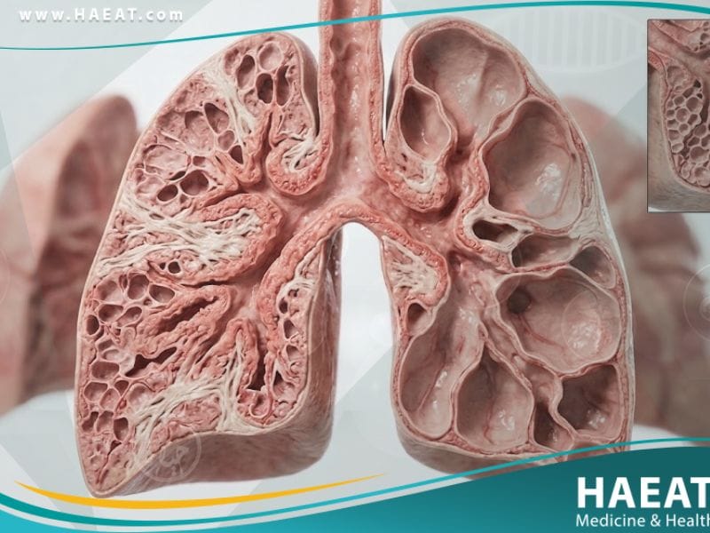 خلل التنسج القصبي الرئوي