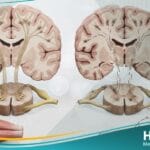 داء العصبون الحركي (1)