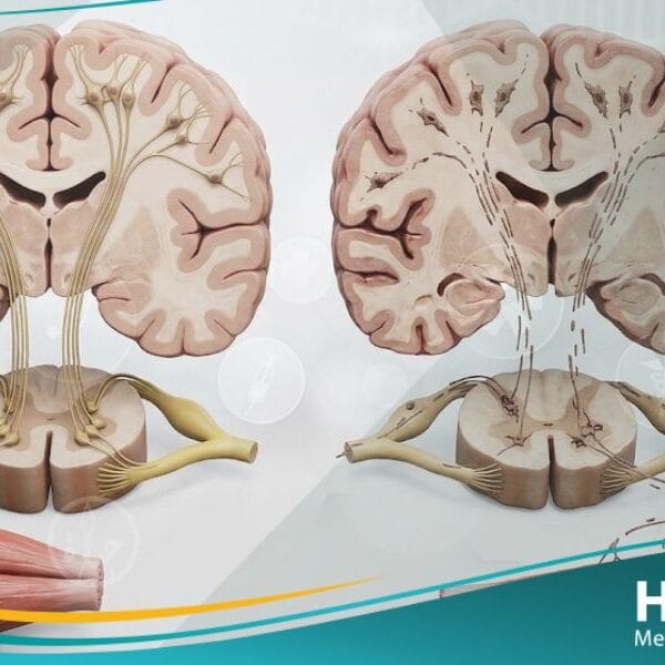 داء العصبون الحركي (1)