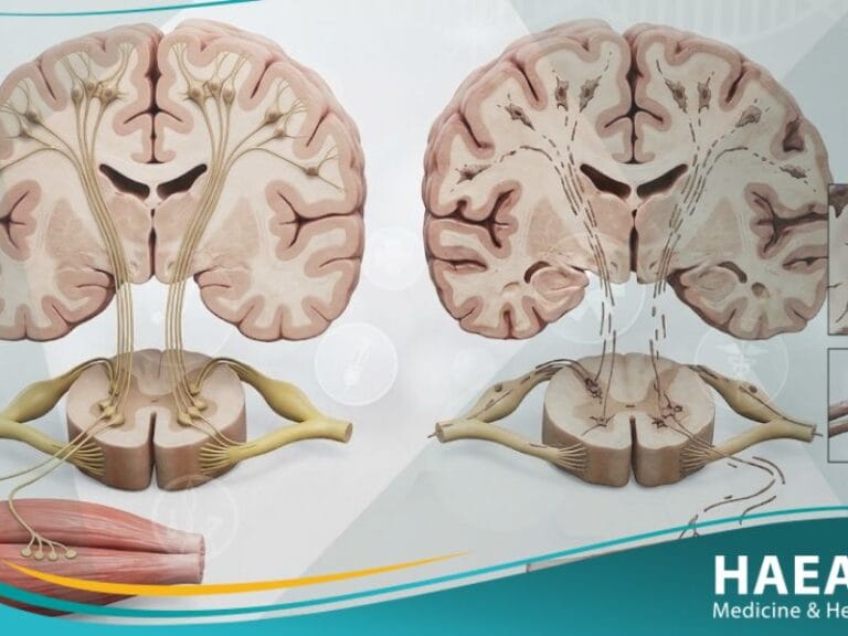 داء العصبون الحركي (1)