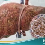 داء ترسب الأصبغة الدموية