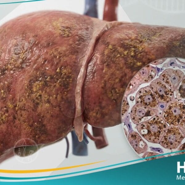 داء ترسب الأصبغة الدموية