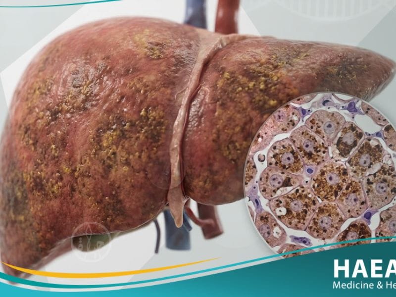 داء ترسب الأصبغة الدموية