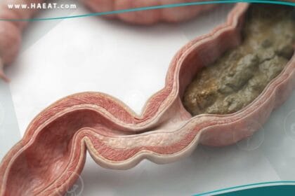 داء هيرشسبرونغ (2)