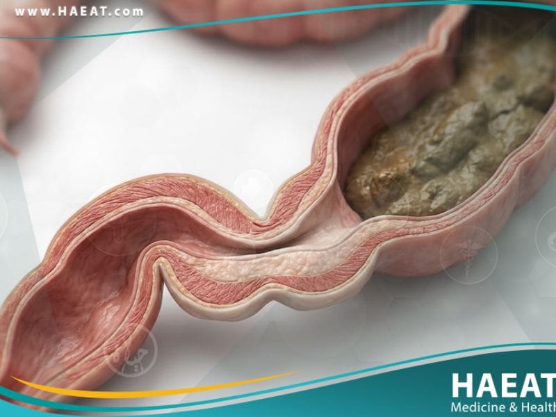 داء هيرشسبرونغ (2)