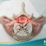 رضح العمود الفقري